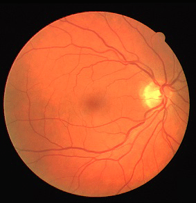 Fundus Image