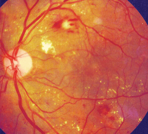 Fundus Image containing Exudates