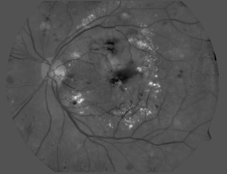 Green Channel of Fundus Image